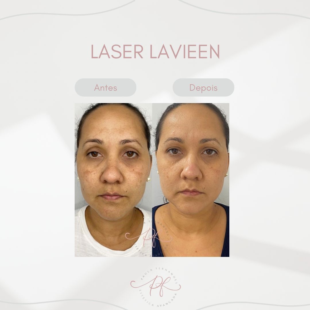 laser